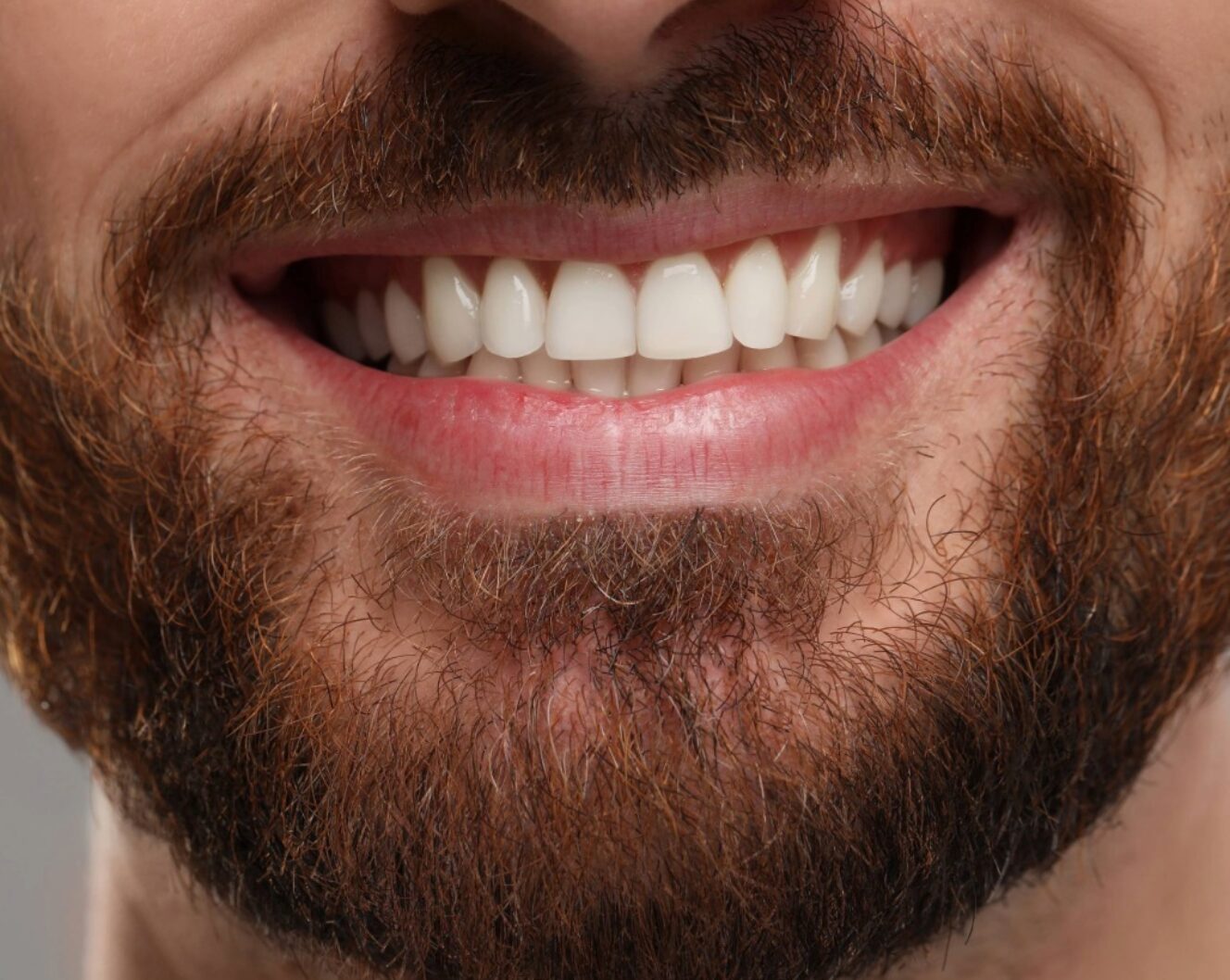 Veneers